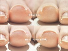 ニコプラス(NICO+)/巻き爪ケア