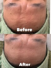 ルーチェ(LUCE)/グリーンピール 3DAYS