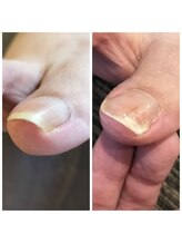 立川巻爪補正院/巻き爪　初回の術前・術後