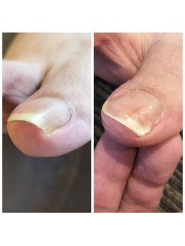 巻き爪　初回の術前・術後