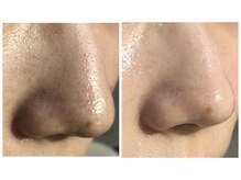 エステサロン ルックス ビューティー(エステサロン Looks Beauty)/毛穴洗浄