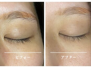 クク 赤坂 天神(99 KUKU)/1回目の施術/目のクマ