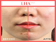 ビンナ(BINNA)/ビフォーアフター【ララピール】