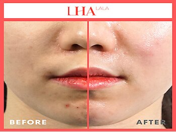 ビンナ(BINNA)/ビフォーアフター【ララピール】