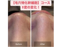 アスボーテ 月島(As Beaute’)/3STEP毛穴洗浄×ヒト幹細胞導入