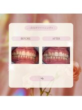 プラスビー 2号店(+b)/ホワイトニングビフォーアフター