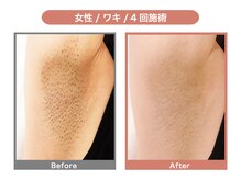 HGB 東山公園駅前店/女性｜20代｜学生