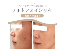 傷にならないから、5日あればシミケアできちゃう！美白シミケア