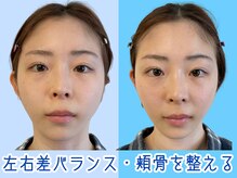 ナチュラルビューティーフェイス 横浜(NBF)/初回/２3才/横浜小顔矯正