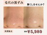 【毛穴の黒ずみでお悩みの方】角質除去イオンピーリング＆引き締めパック