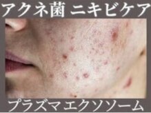 マヴィ 今福鶴見店(MavY.)/ニキビケア