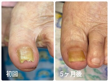 ドクターネイル爪革命　松戸 【巻き爪・魚の目・角質ケア・変形爪】/巻き爪　爪切り