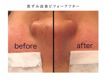 ベベ もりの里店(Be'be')の雰囲気（黒ずみ改善ビフォーアフター）