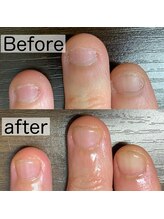 アカツキネイル(Akatsuki Nail)/爪育成　3週間後