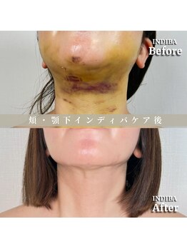 術後の女神 大阪心斎橋店/術後ケアインディバ・インディバ