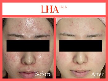 ビンナ(BINNA)/ビフォーアフター【ララピール】