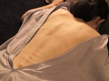 旭堂/股関節のお悩み鍼灸/￥8,300