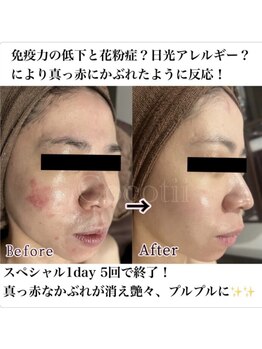 ココティー 大阪店(Cocotii)/スペシャル1day5回のケアの変化