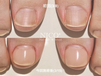 ニコプラス(NICO+)/巻き爪ケア