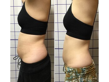 アリス フィットネスサロン/*ウエスト施術効果*