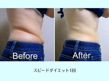 リクラ(Reclat)/スピードダイエット1回