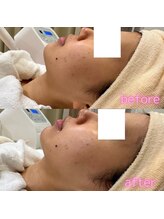 エミュ(emu)/◆フェイシャルエステ体験後