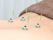 了鍼灸整骨院/鍼灸施術で自律神経調整