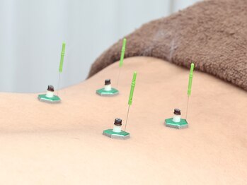 了鍼灸整骨院/鍼灸施術で自律神経調整