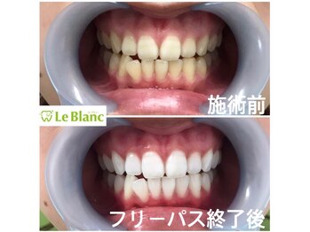 ルブラン 奈良店(Le Blanc)/綺麗な歯で