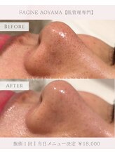 ファシネアオヤマ(FACINE AOYAMA)/綺麗な素肌へ導きます！