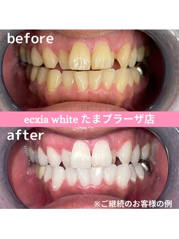 エクシアホワイトニング たまプラーザ店/ビフォーアフター