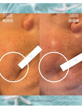 ポノ(Pono)/くすみやシミでお悩みの方。