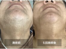 リリー(RILY)の雰囲気（1番人気のヒゲ脱毛♪髭剃り不要に最短で導きます!メンズ脱毛/VIO）