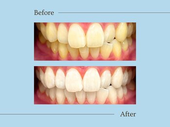 ルアナ(Luana)/初回Naturalメニュー施術例