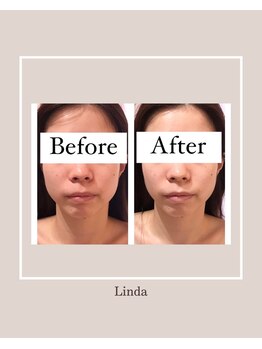 リンダ 西宮店(LINDA)/サーマルリフトRF