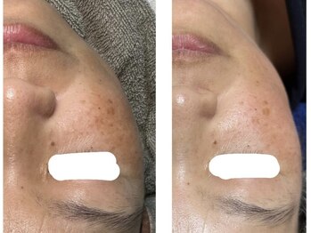 ルビー(Ruby)/【50代】ハーブピーリング2回