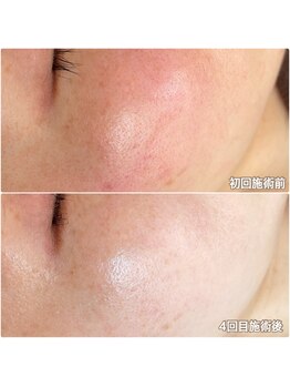 クロッシュ(Cloche)の写真/【何をしたら良いか分からない方へ◎】丁寧なカウンセリングで肌質や悩みに合わせた施術。理想の素肌へ!