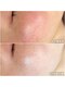 クロッシュ(Cloche)の写真/【何をしたら良いか分からない方へ◎】丁寧なカウンセリングで肌質や悩みに合わせた施術。理想の素肌へ!