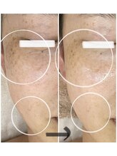 エステサロンパリス(Esthe Salon Paris)/一度で実感！純粋レチノール最高