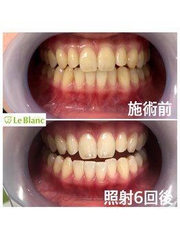 ルブラン 奈良店(Le Blanc)/効果が早い!