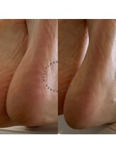 アリュー(Allu)/韓国式フット角質ケア