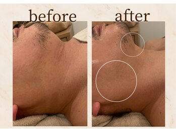 アンバー 恵比寿(AMBER)/小顔リフトアップ