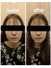 【初回お試し美容鍼】　30分　4,000円 肌質改善　リフトアップ　眼精疲労　　