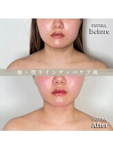 術後の女神 大阪心斎橋店/術後ケアインディバ・インディバ