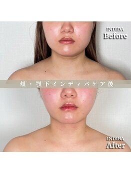 術後の女神 大阪心斎橋店/術後ケアインディバ・インディバ