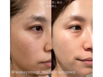 リンク(Linc)の写真/【堅田駅3分】美容に特化の若よもぎ蒸しで潤う艶肌へ!乾燥・肌荒れ・くすみ改善で理想のトーンアップ♪