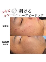 ハーブのほし/ニキビケアに特化！メンズも◎