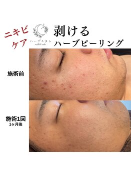 ハーブのほし/ニキビケアに特化!メンズも◎