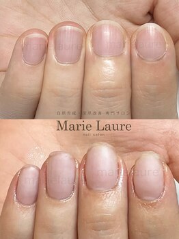 マリーロール 梅田店(Marie Laure)/自爪育成/深爪矯正/ネイルケア