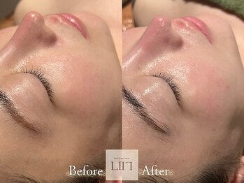 エル 麻布十番/たるみ/小顔/毛穴/フェイシャル